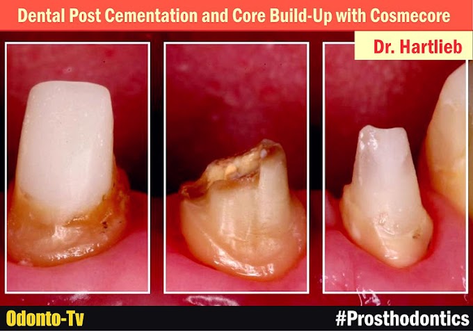 ENDOPOST: Dental Post Cementation and Core Build-Up with Cosmecore