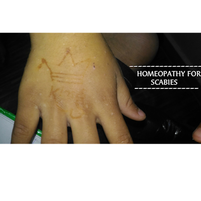 Top 4 Homeopathic remedy for scabies