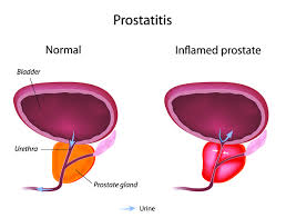 prostatitis tips