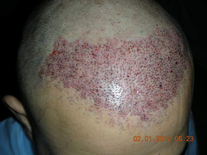 Hair Transplant,Hair Restoration,FUE in Ireland