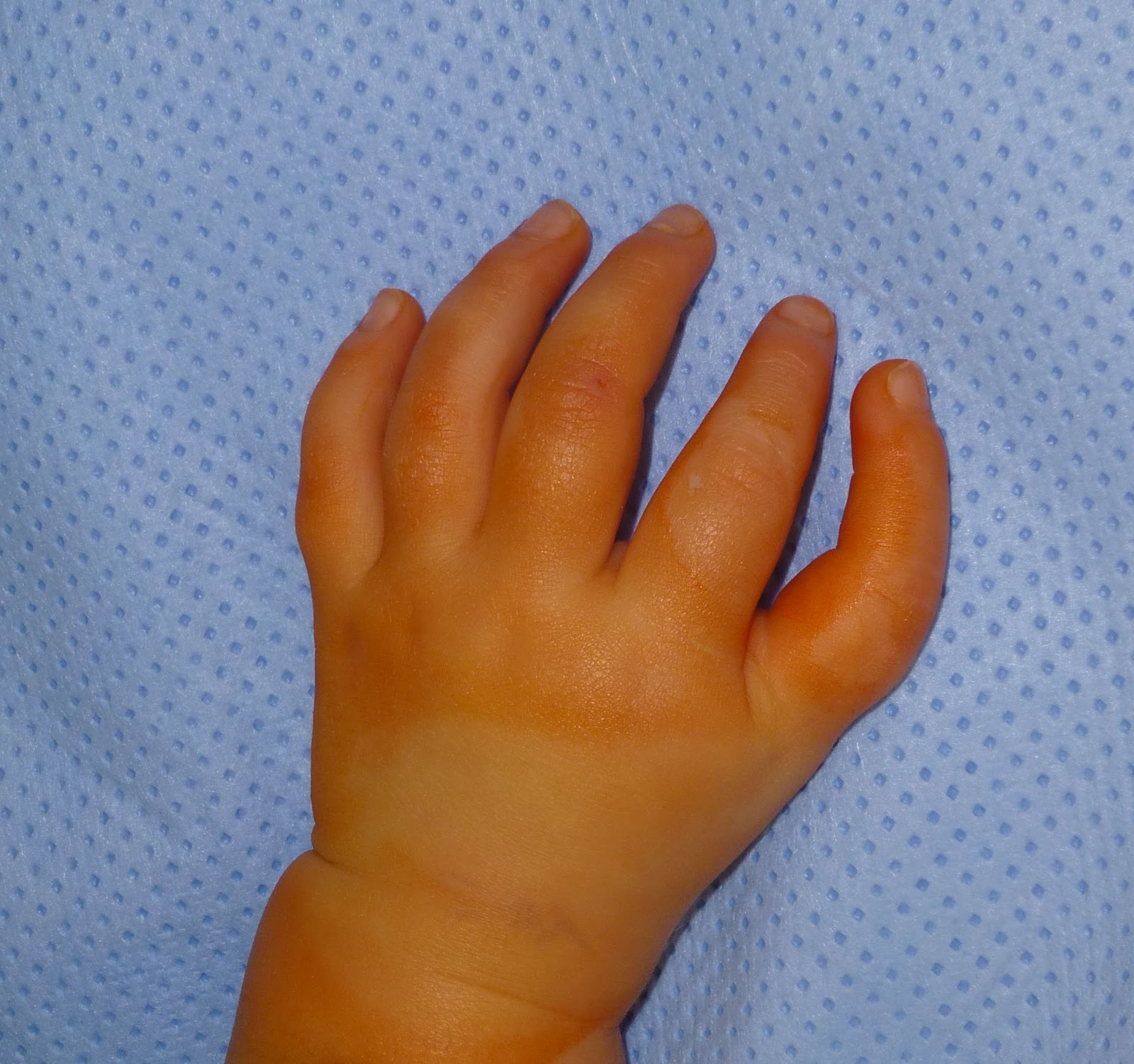 Hand-Foot Syndrome - Managing Side Effects - Chemocare
