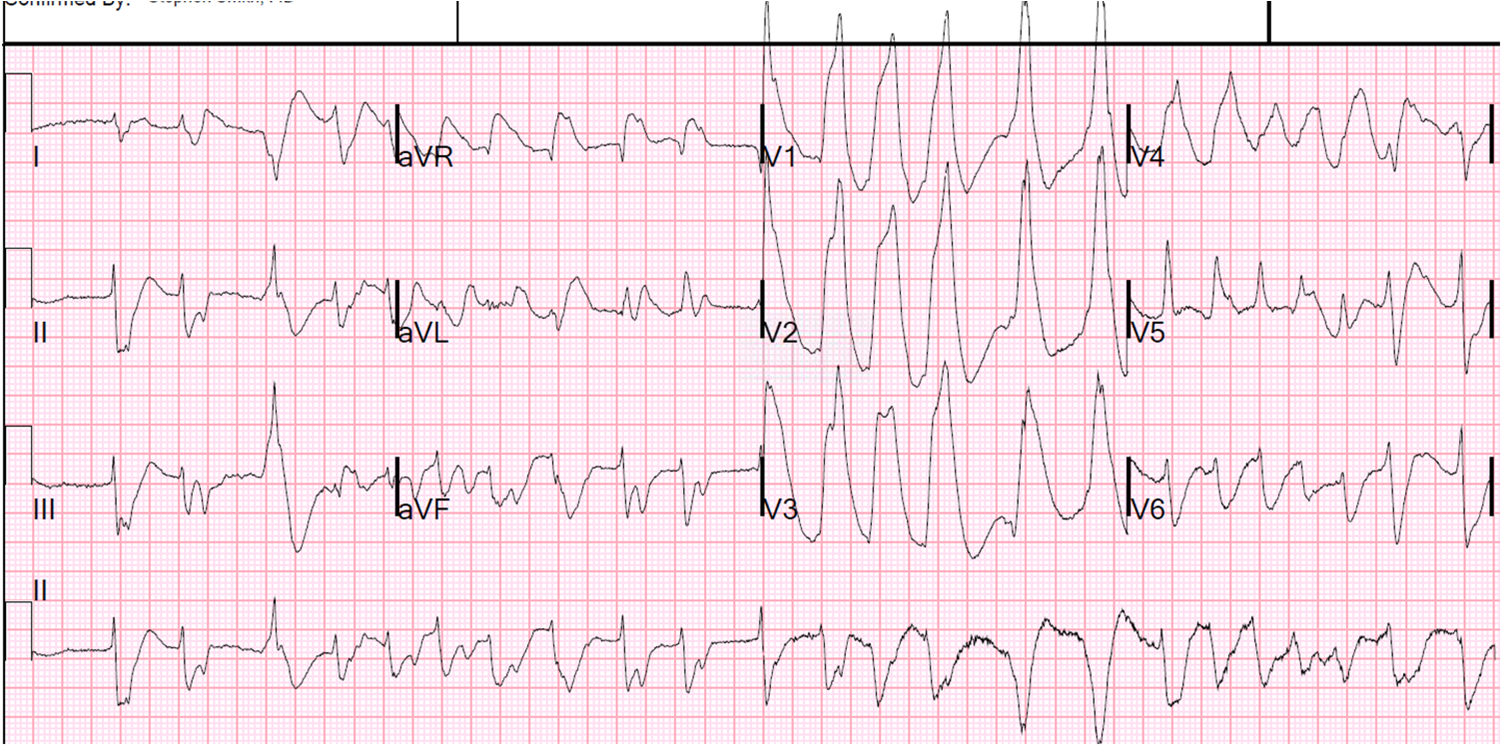 Dr. Smith's ECG Blog Prolonged (63 minutes) Ventricular Fibrillation