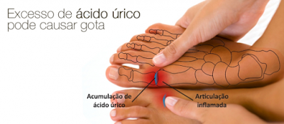 Ácido úrico ou Gota