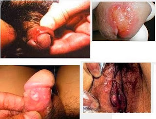 Image Merk dan harga obat penyakit sipilis pada pria