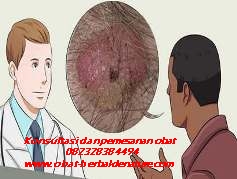 virus papiloma manusia obat antitumor topikal