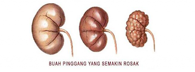 Antara tanda masaalah sakit buah pinggang adalah kencing anda berbuih