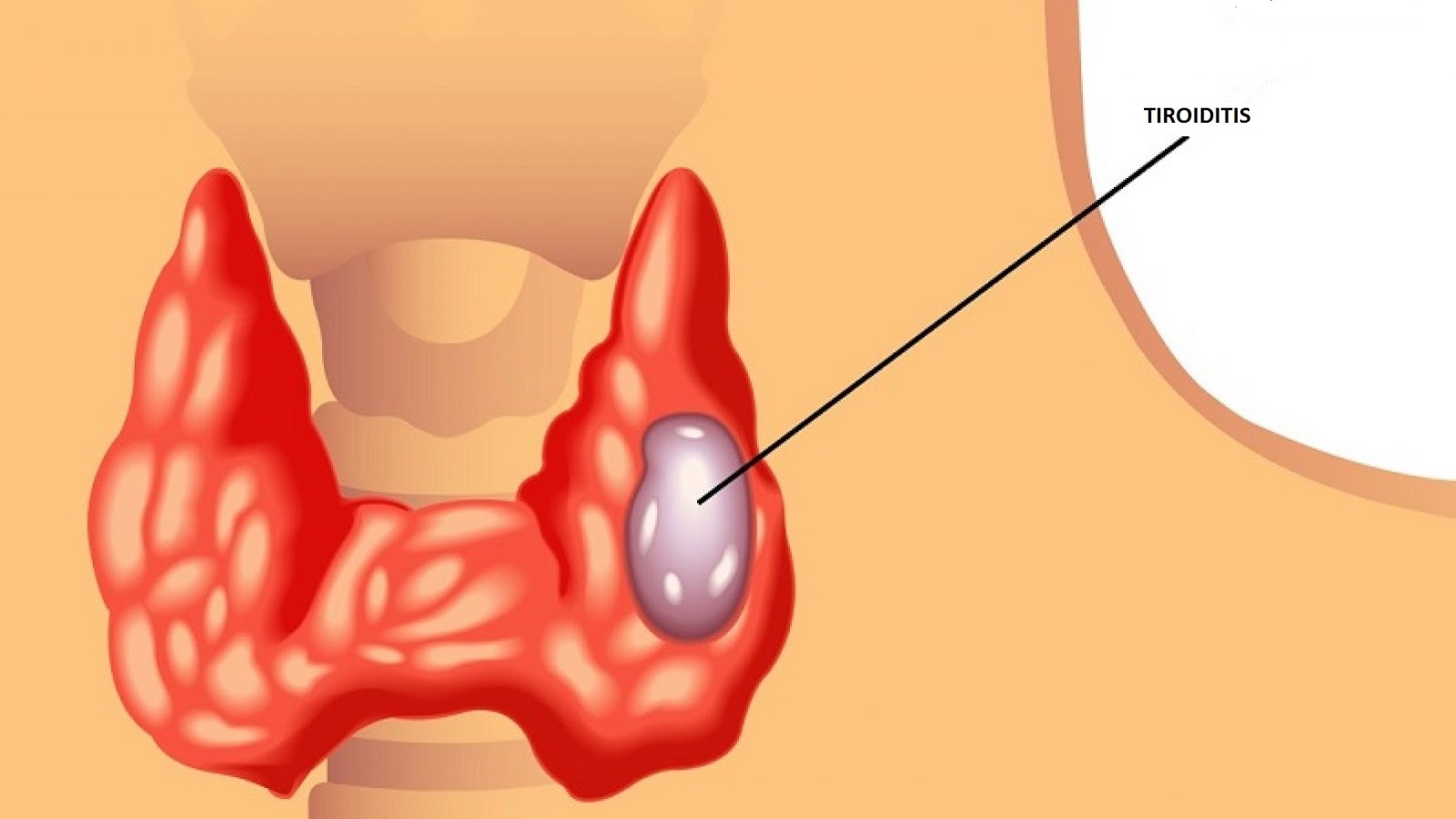Зоб ахан. Узловой зоб щитовидной железы. Аденоматозный зоб щитовидной железы. Щитовидная железа зоб узлы.