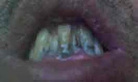 Mal de dents sont des douleurs atroces