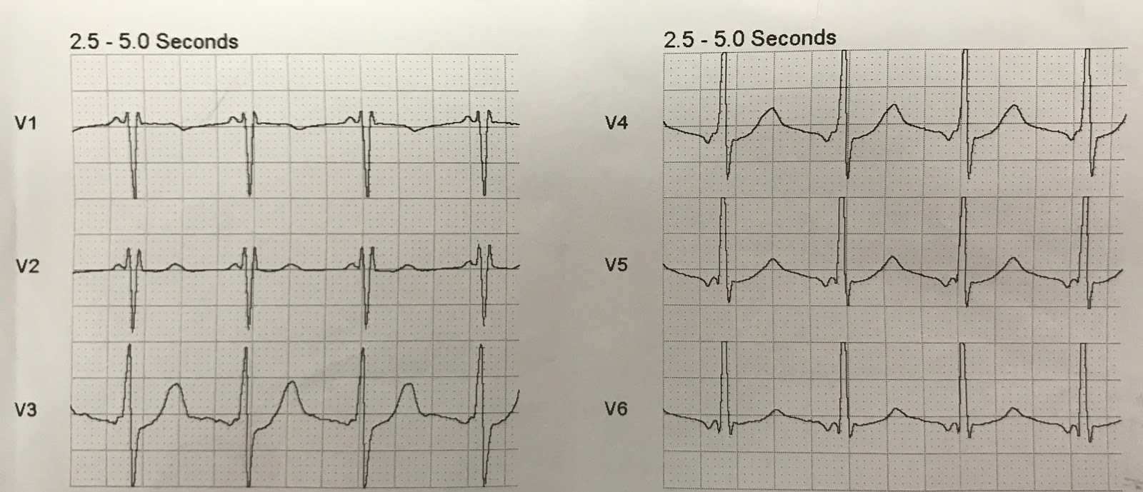 Dr. Smith's ECG Blog Syncope and Prehospital Cath Lab Activation for