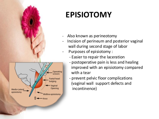 Episiotomy