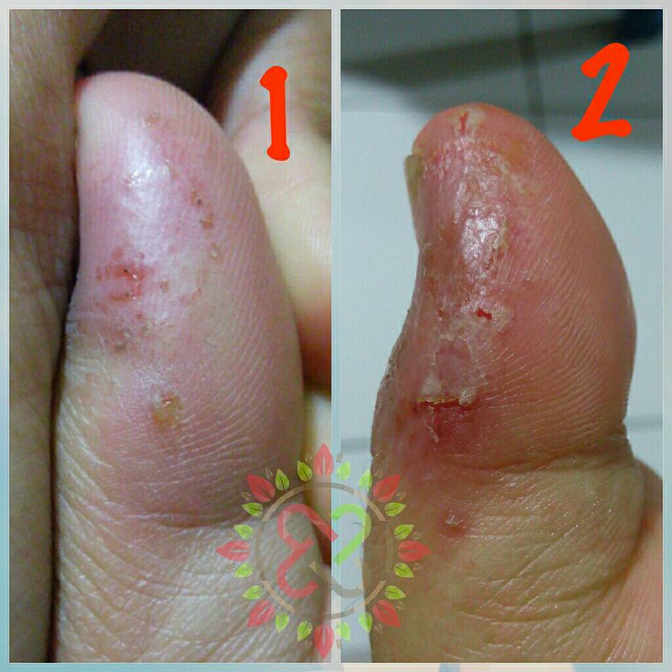 Memprosakan Hidup Pengalamanku Menghadapi Penyakit Dishidrosis