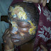 Jealous Lady Baths Her Fellow Housewife With Hot Water In Yobe State - Graphic Photos