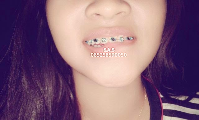 Koleksi Foto Senyum Behel Cantik dan Model Warna Karet