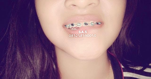 Info Spesial Warna Karet Behel Yang Lucu
