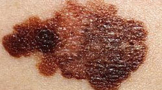 MELANOMA kanker kulit