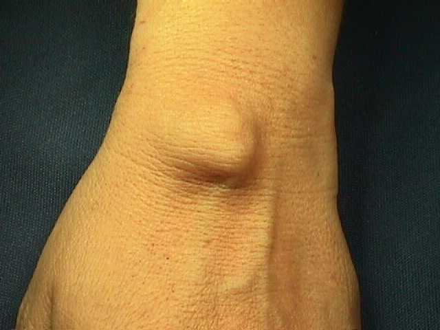 OSSA CARPALIA ©: GANGLION DE LA MUÑECA.