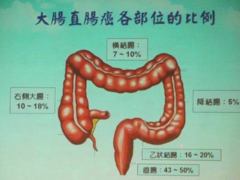 直腸癌術前治療 免做人工肛門