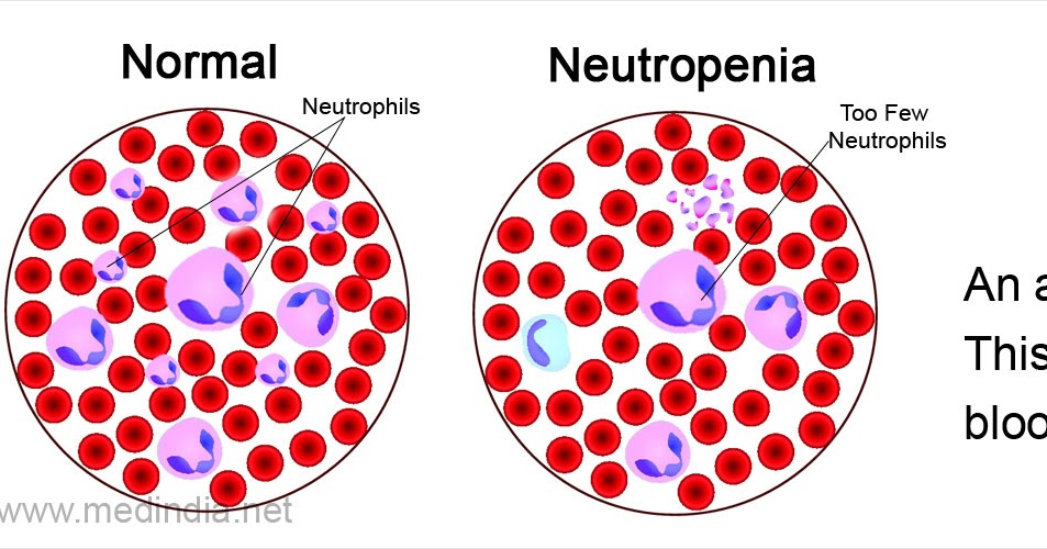анизо-пойкилоцитоз жда. первичная нейтропения бывает:. доброкачественная нейтропения детского возраста. анемия нейтропения. нейтропения картина крови.