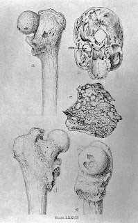 Το αρχαιότερο δείγμα καρκίνου εντοπίστηκε σε απολιθωμένο οστό  