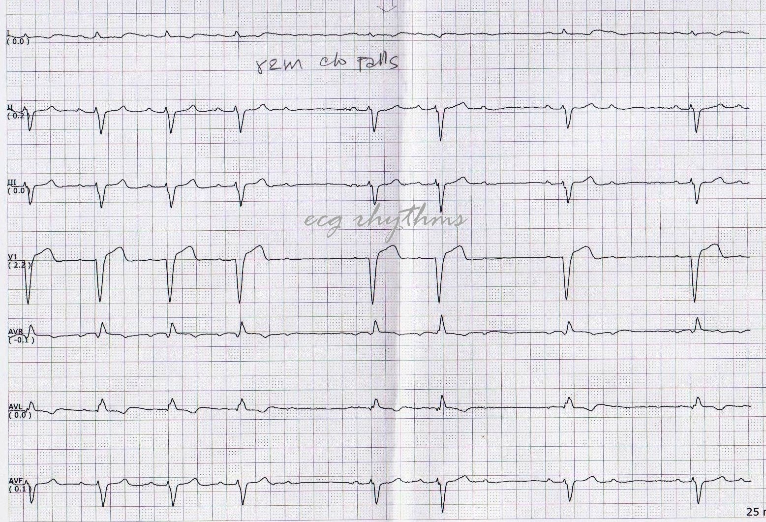 Ecg Rhythms Basic Ecg Interpretation