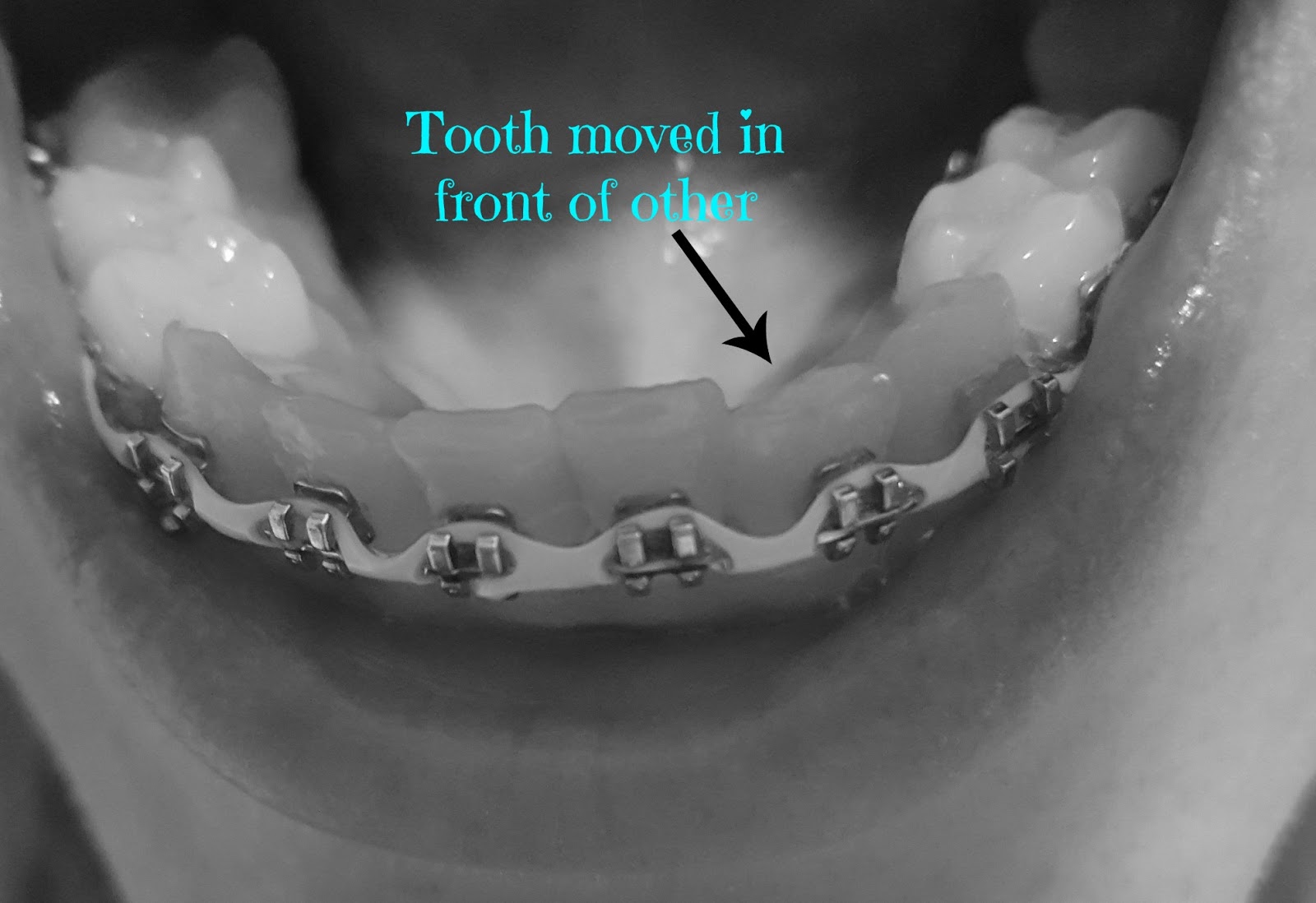 Adult Braces My Journey Last Braces Adjustment & Impressions for