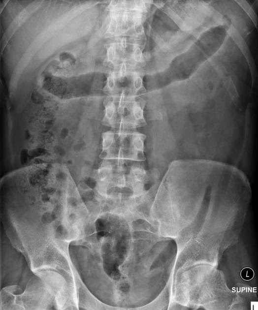Study Medical Photos 45 Years Old Male With Abdominal Pain And Diarrhea For 3 Weeks