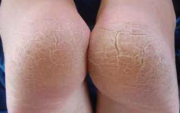 How to get rid of calluses on feet