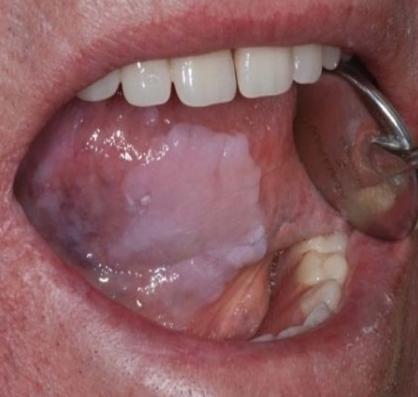 mouth yeast infection #11