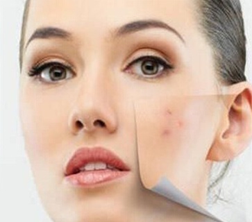 How To Get Rid Of Acne, How To Get Rid Of Acne Fast, Home Remedies For Acne, Acne Treatment, How To Cure Acne, Acne Home Remedies, How To Cure Acne Fast, Acne Remedies, Home Remedies For Acne Treatment, Easy Acne Treatment, Acne Treatment, How To Treat Acne Fast