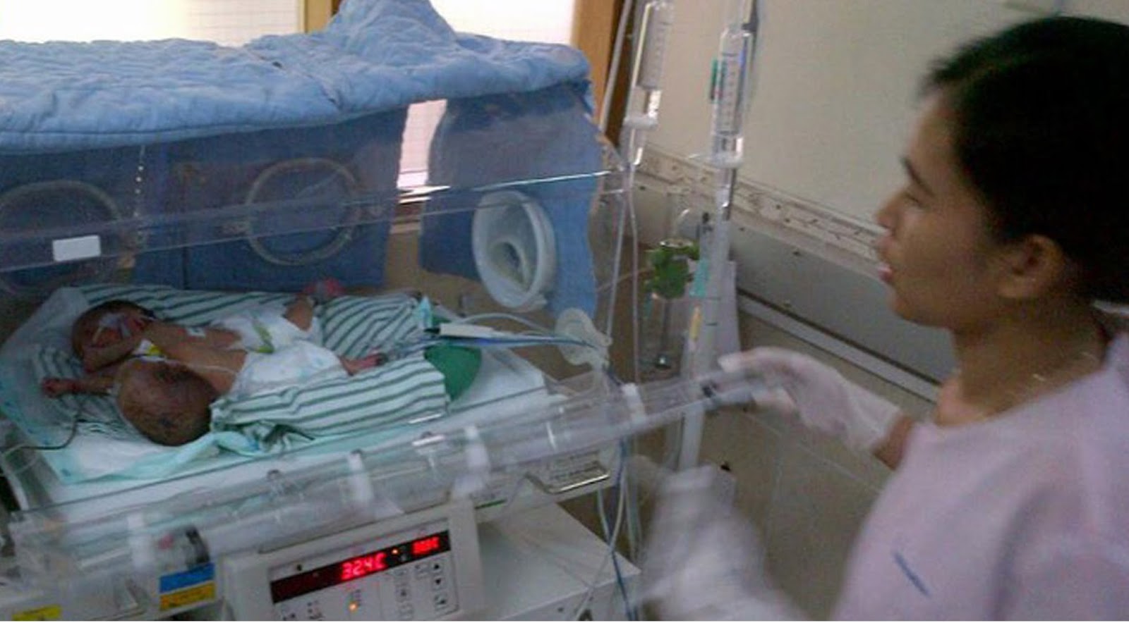 Bayi kembar siam dari Asahan  Fahira dan Sahira Bayi kembar siam dari Asahan  Fahira dan Sahira