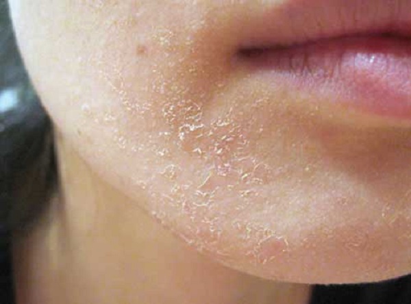 Điều trị bệnh chàm khô Điều trị bệnh chàm khô