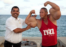 جنون الشهرة: رجل يخاطر بحياته من تضخيم عضلاته!