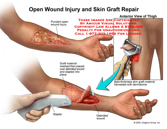 YANZHE INJEKSI: Perawatan Luka