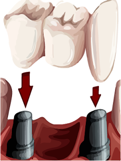 Dental bridge