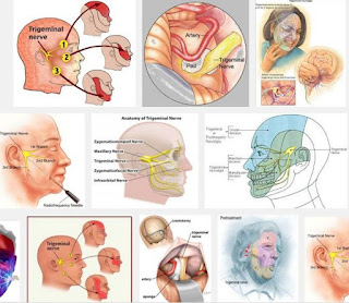 meningioma, occipital neuralgia trigeminal,post herpetic neuralgia, numb face, atypical trigeminal neuralgia, occipital neuralgia treatment