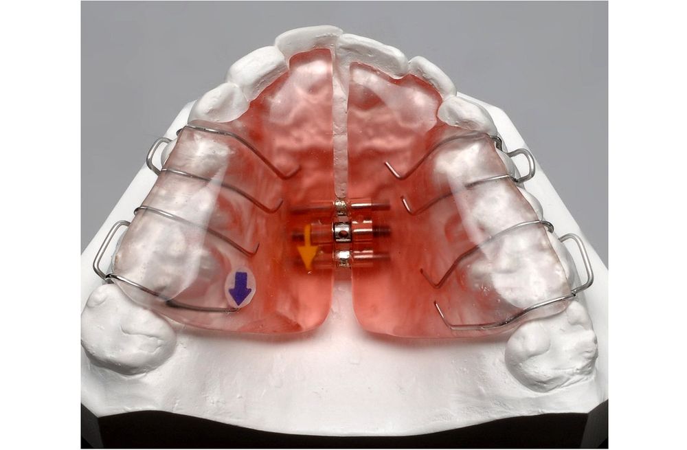 ORTOPEDIA Función de la placa con tornillo de expansión