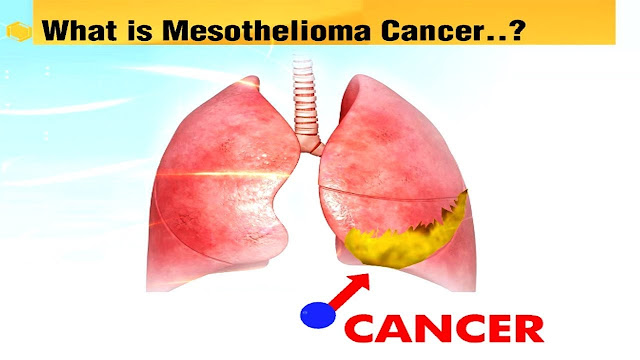 malignant mesothelioma icd codes