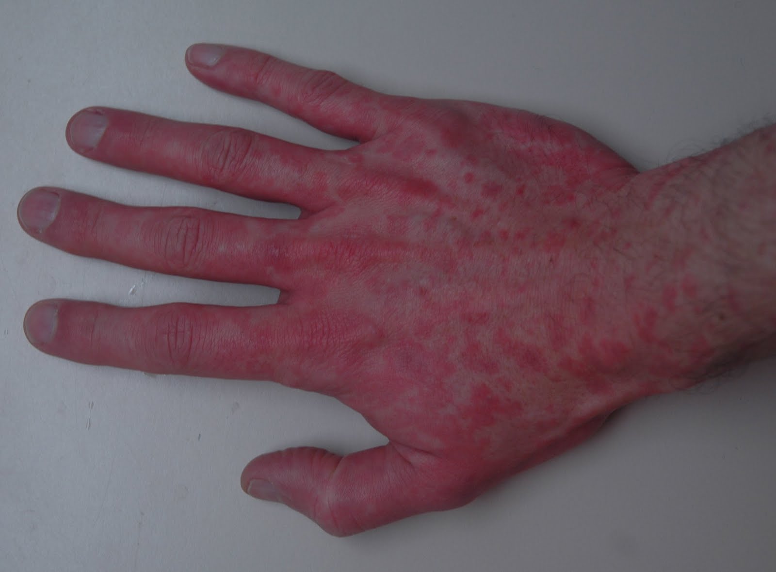 What causes reddened hands? | Reference.com