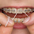 Các nguyên nhân gây móm răng bạn nên biết