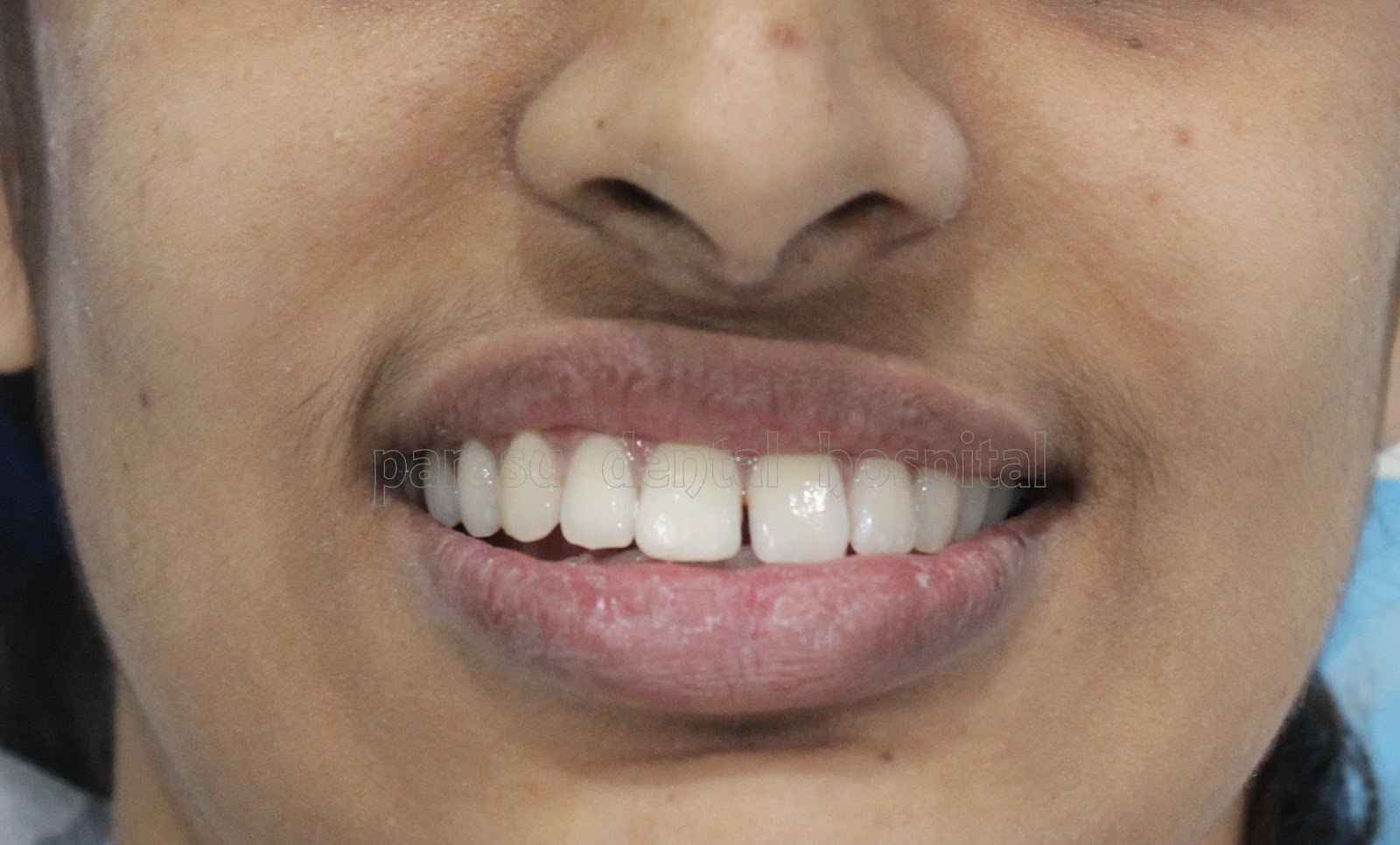 Dental Xray Center In Medavakkam Broken Front Tooth Filled With Tooth Coloured Filling 