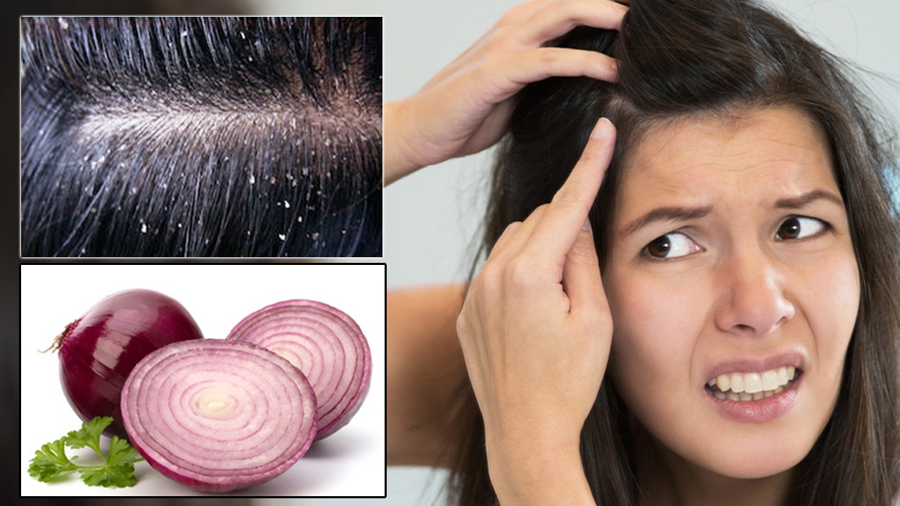 Benefits of onions for your skin and hair with weight loss LifeStyle