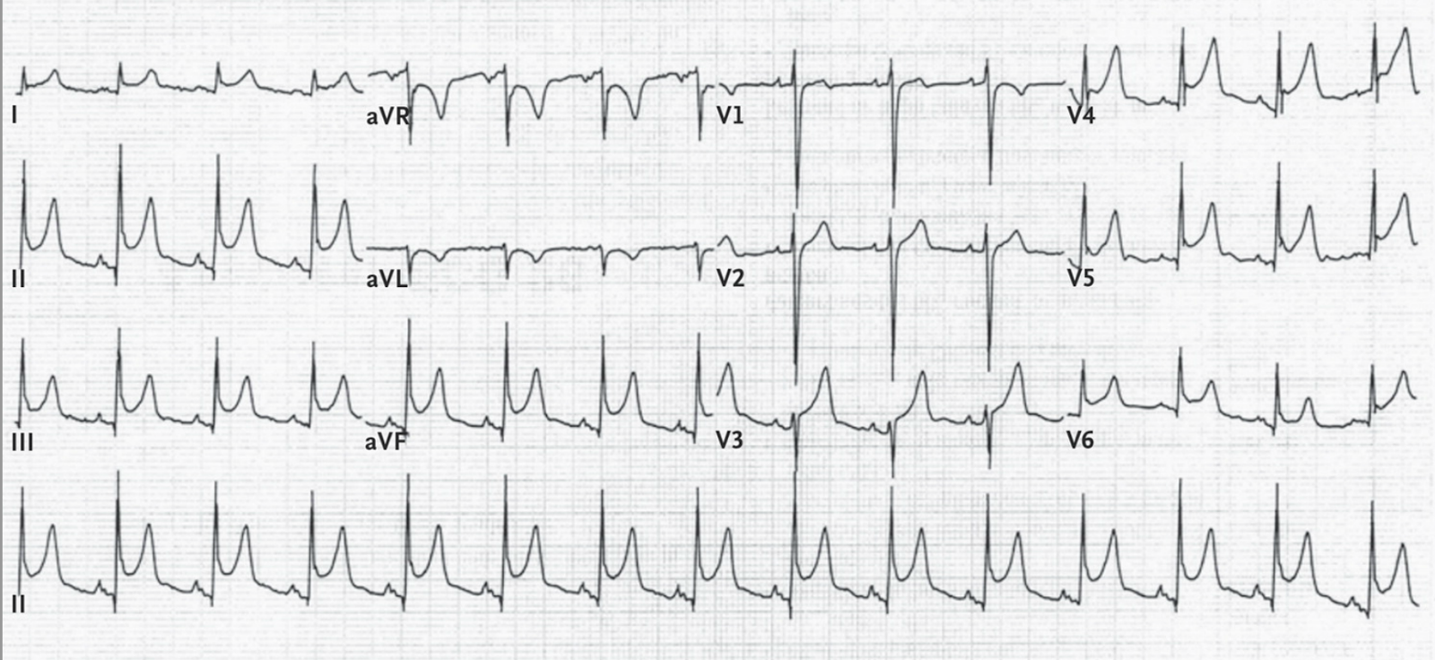 Dr Smith S Ecg Blog Why Is There St Depression In Avl In This Case Of Pericarditis