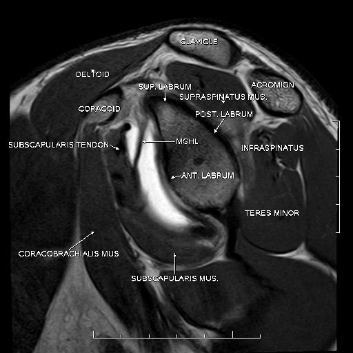MR Arthrography Shoulder - Sumer's Radiology Blog