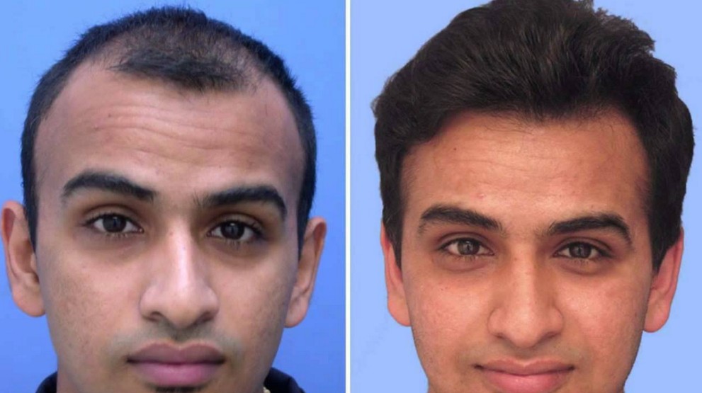 hair transplants results