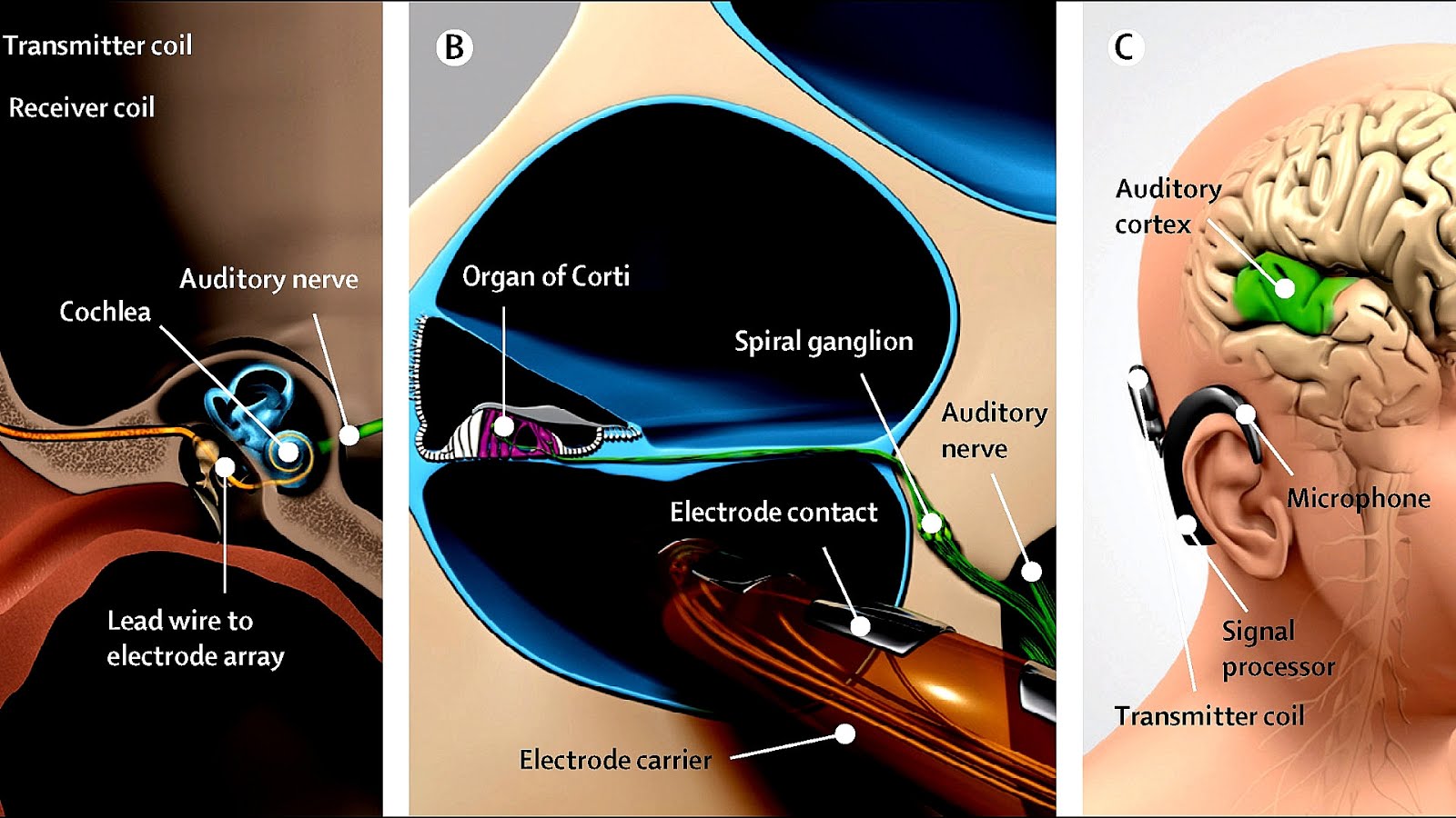 How Effective Are Cochlear Implants In Restoring Hearing - Effect Choices