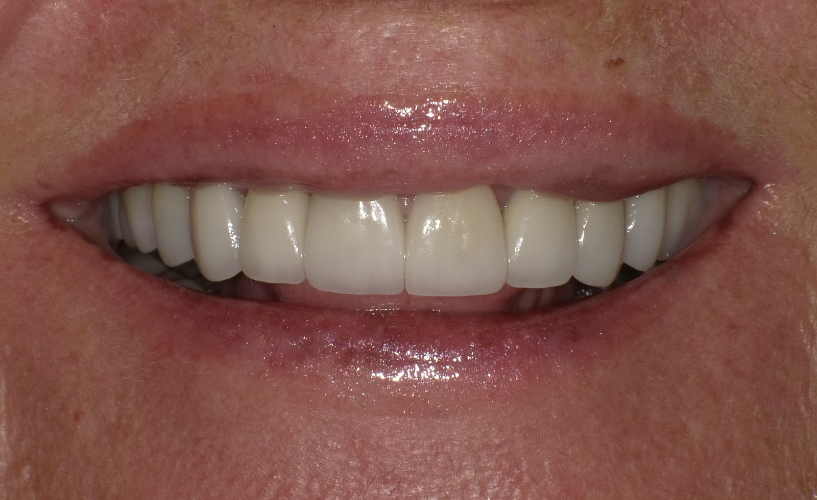 Riverview Cosmetic Dentistry Dr. Hooks Outlines the steps he utilized