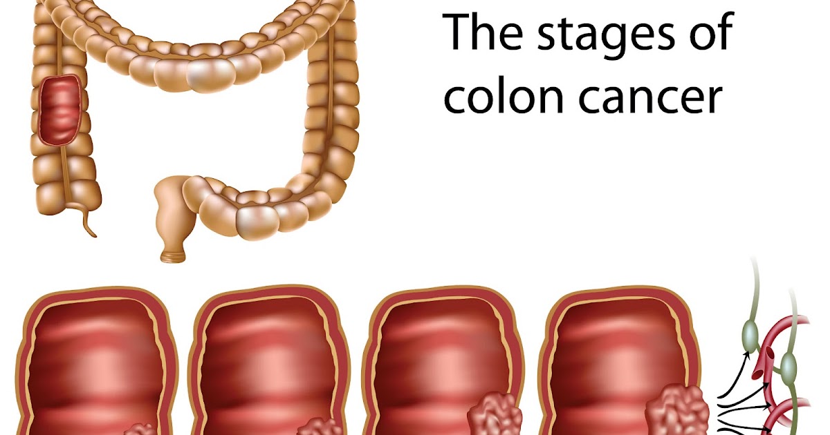Colon Cancer Treatment: Colorectal Cancer Stages and Treatment Options