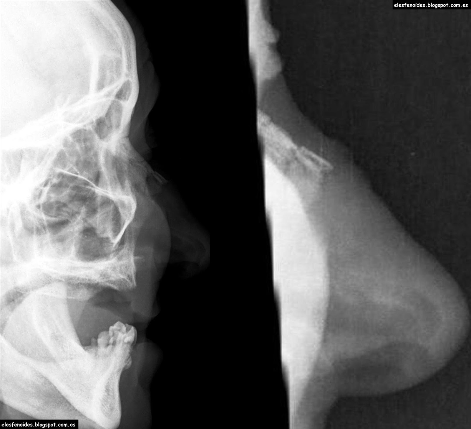 El esfenoides: Fractura de huesos nasales. 2 imágenes 1 caso.