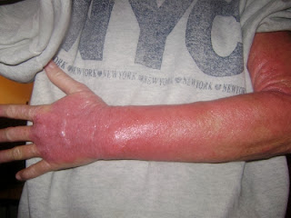 red hot steroid addicted arm