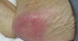 ENFERMERÍA - NURSING: THE PREVENTION AND TREATMENT OF ...